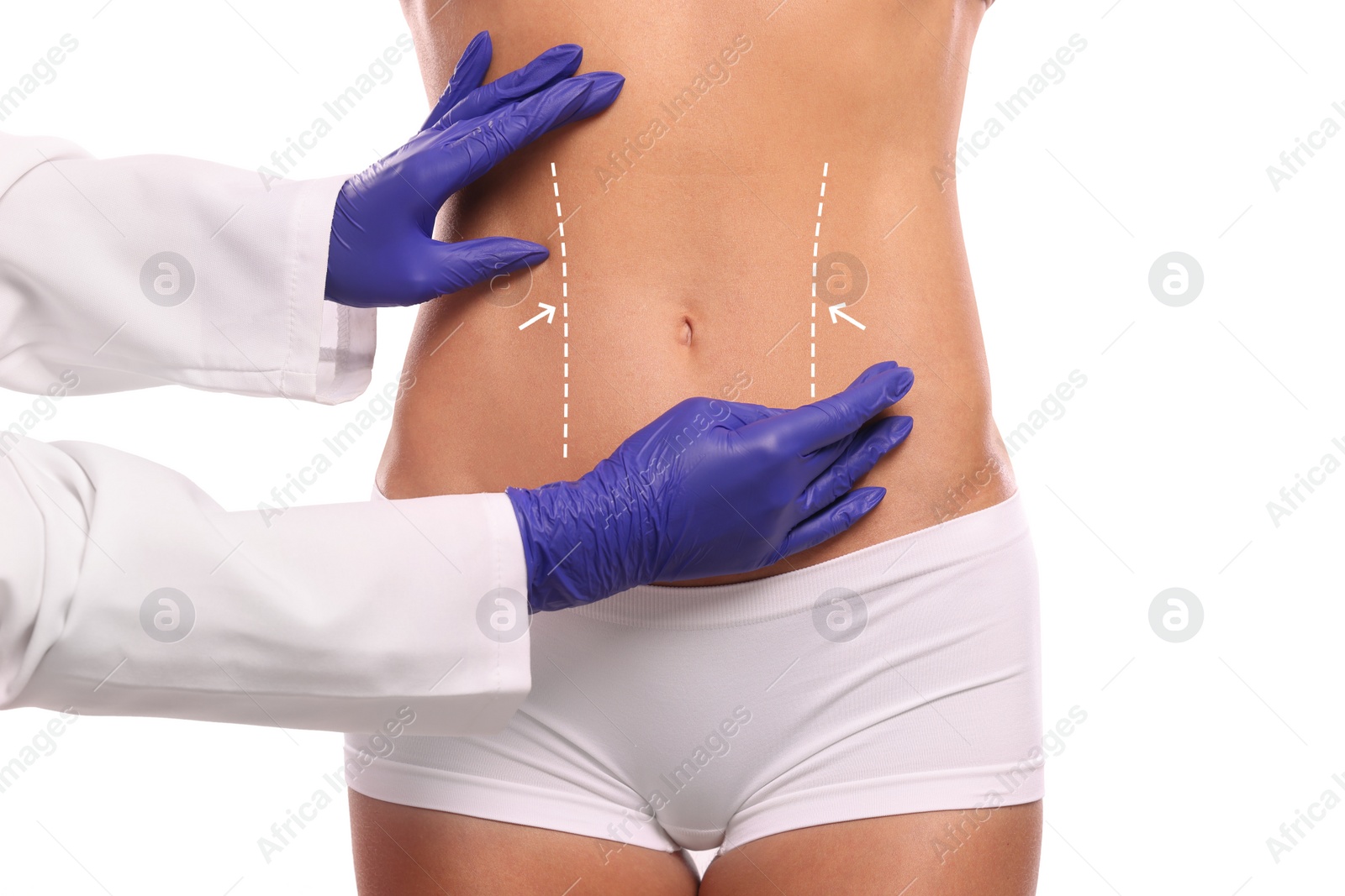 Image of Doctor and patient preparing for cosmetic surgery, white background. Woman with markings on her abdomen, closeup