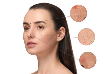 Image of Dermatology. Woman with skin problem on white background. Zoomed areas showing acne
