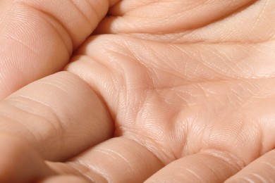 Photo of Closeup view of human hand with dry skin