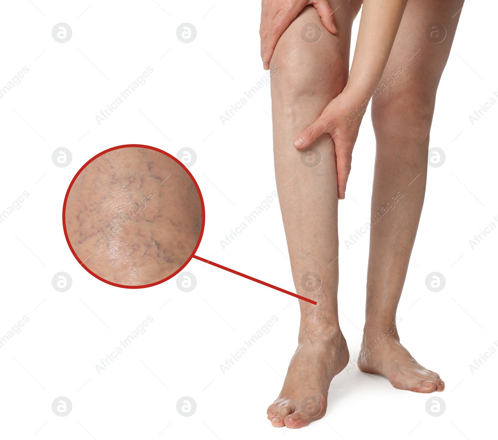 Image of Woman suffering from varicose veins on white background, closeup. Magnified skin surface showing affected area