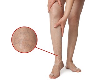 Image of Woman suffering from varicose veins on white background, closeup. Magnified skin surface showing affected area