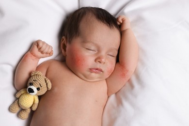 Image of Cute little baby with allergic redness sleeping on soft bed, top view