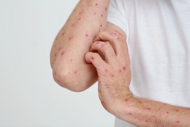 Man with rash suffering from monkeypox virus on light background, closeup