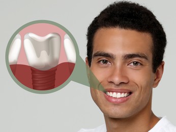 Image of Happy African American man with perfect teeth smiling on light grey background. Illustration of dental implant