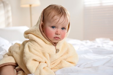 Cute little baby with allergy symptoms on cheeks at home