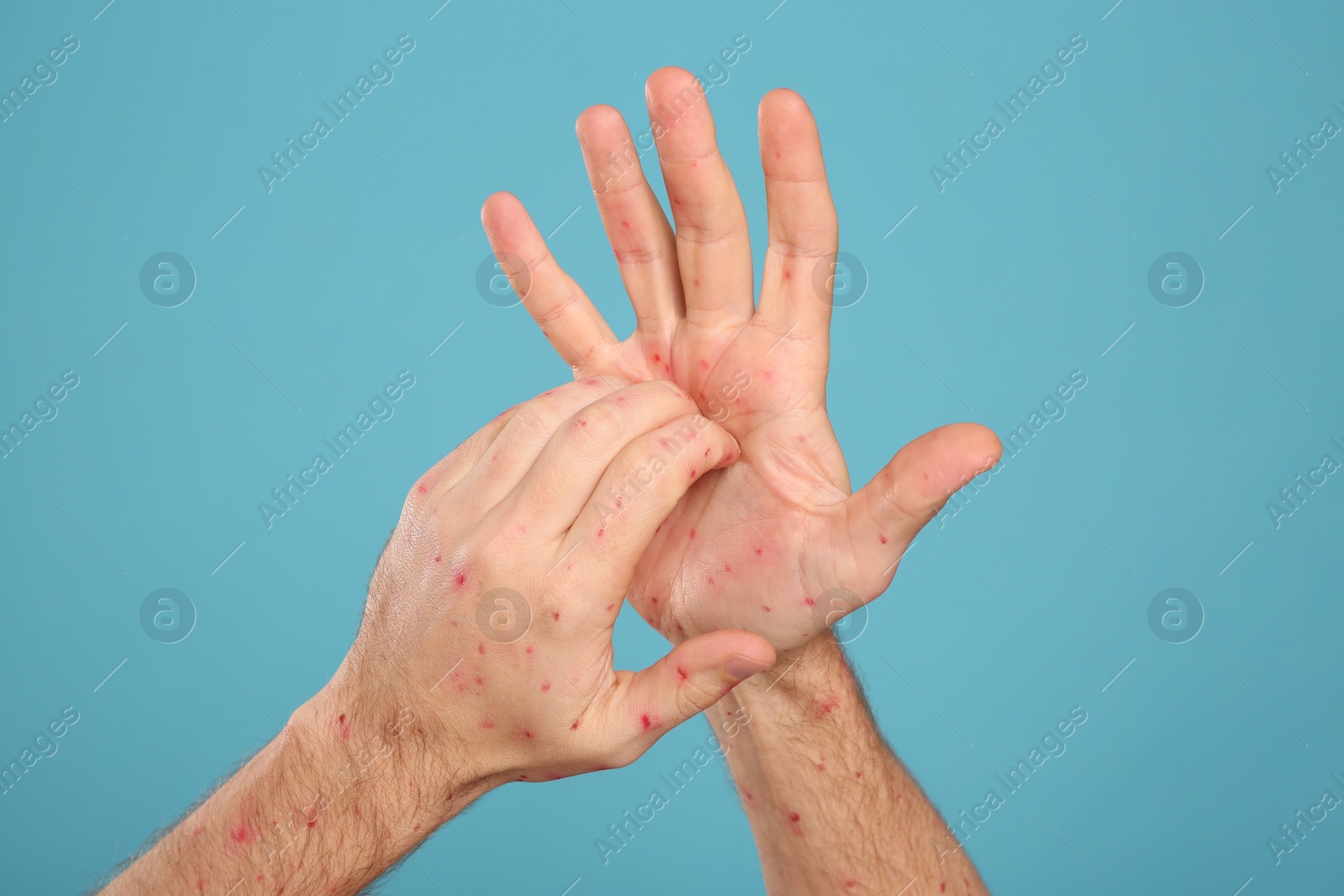 Photo of Man with rash suffering from monkeypox virus on light blue background, closeup