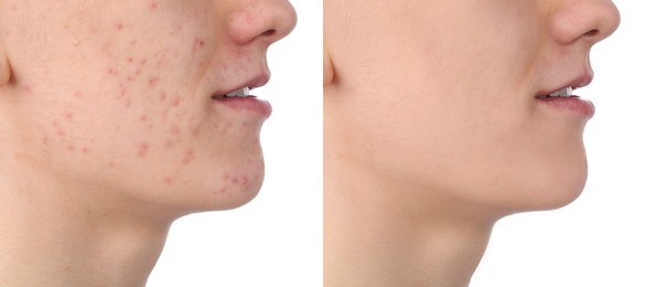 Image of Acne problem. Young man before and after treatment on white background, closeup. Collage of photos