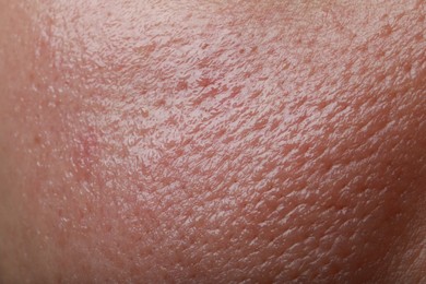Photo of Closeup view of human oily skin as background