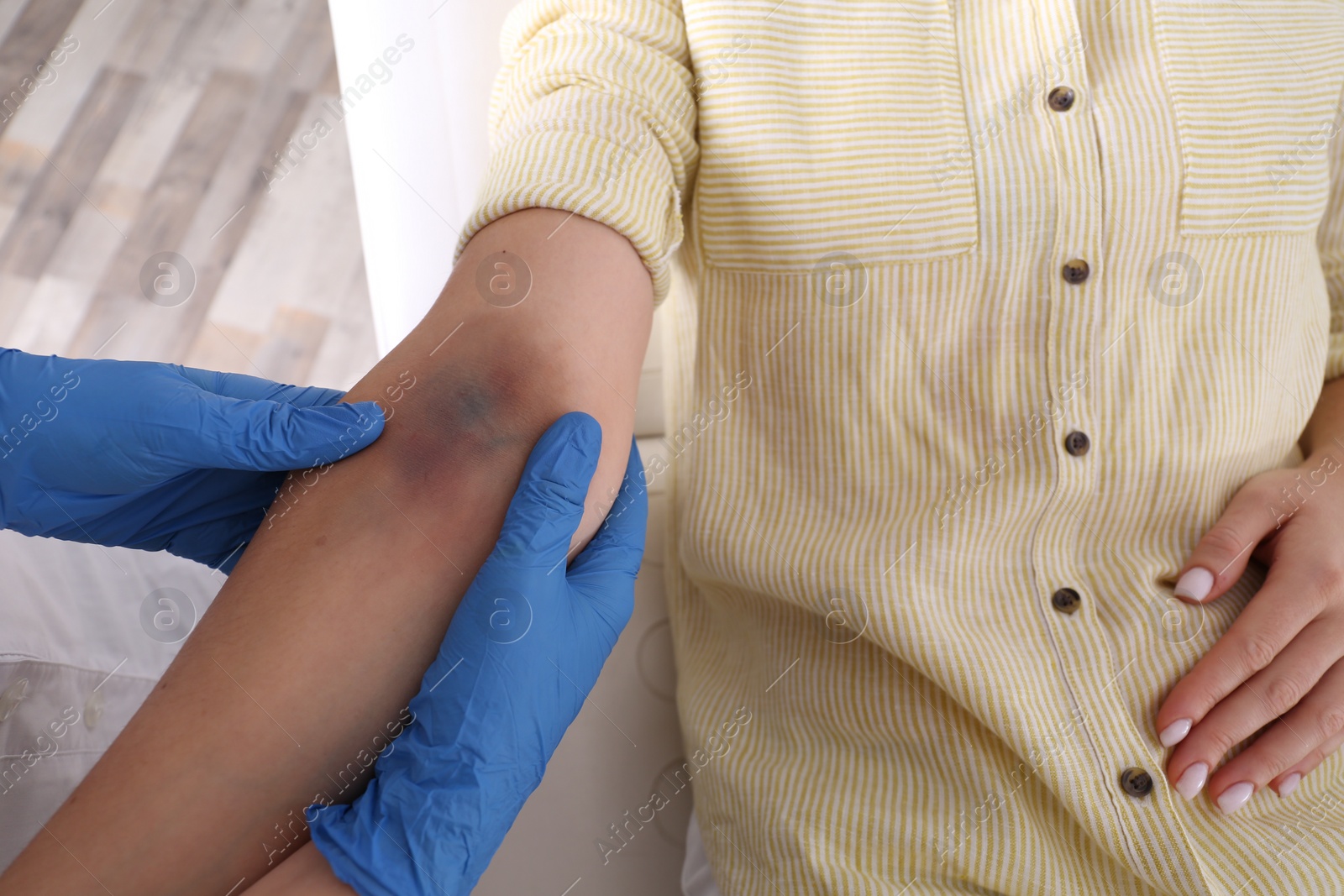 Photo of Doctor checking woman's elbow with bruise at hospital, closeup