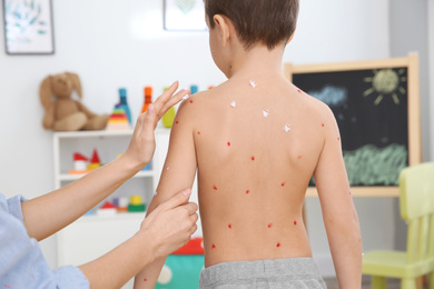 Photo of Woman applying cream onto skin of little boy with chickenpox at home