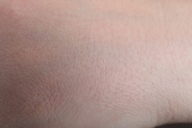 Photo of Woman with dry skin on hand, closeup