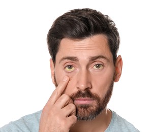 Photo of Man with yellow eyes on white background. Symptom of hepatitis