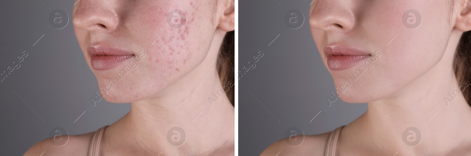 Image of Acne problem. Young woman before and after treatment on grey background, closeup. Collage of photos