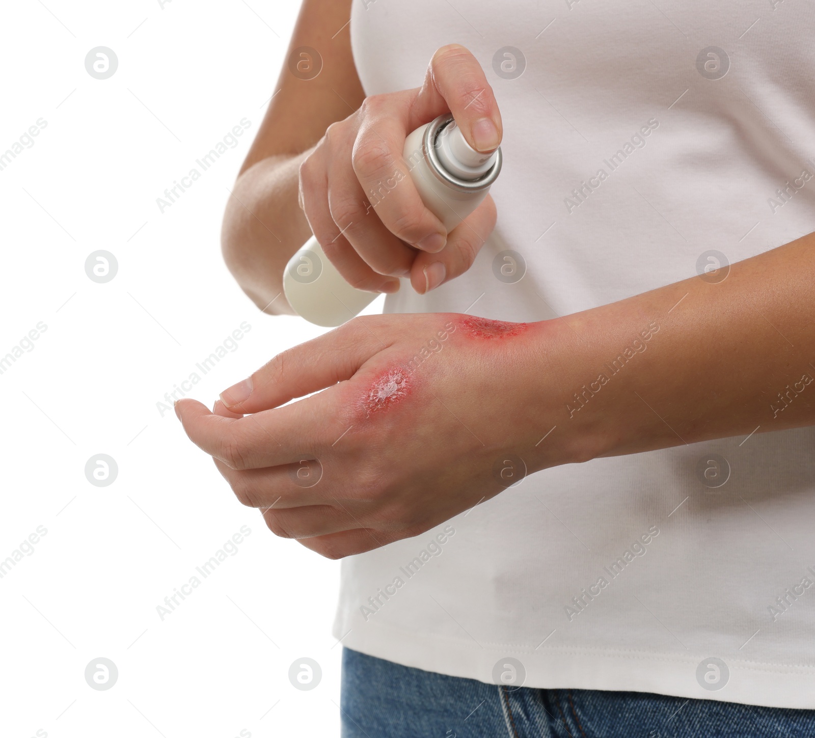 Photo of Woman applying panthenol onto burned hand on white background, closeup