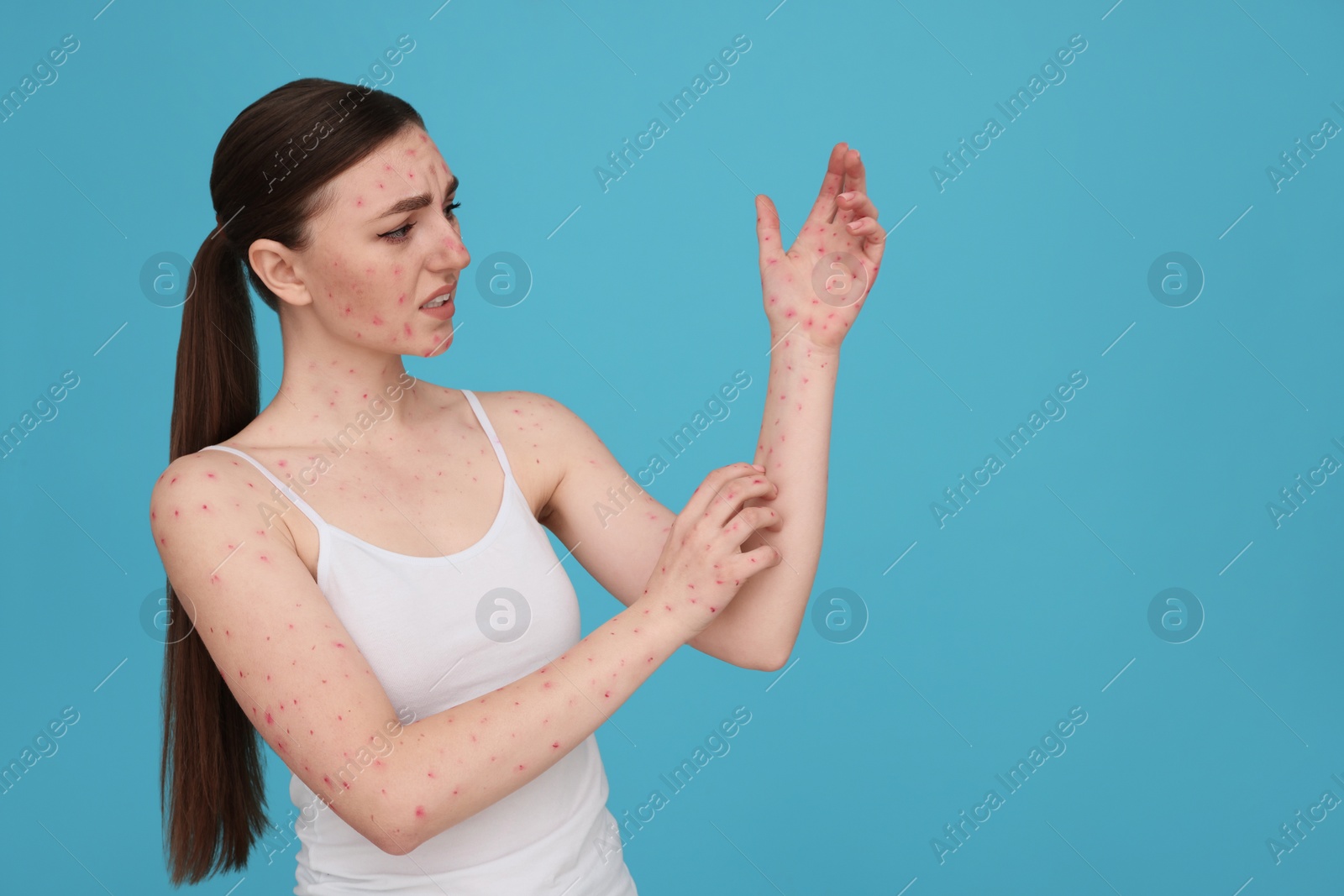 Photo of Woman with rash suffering from monkeypox virus on light blue background. Space for text