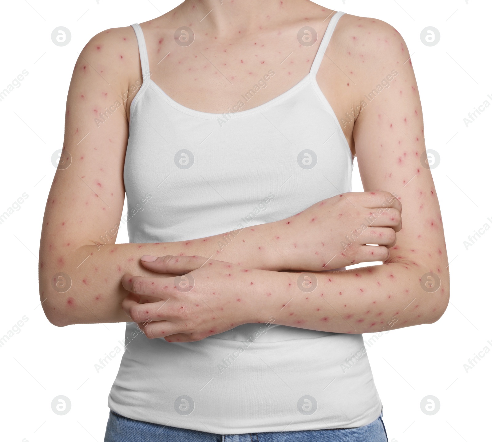 Photo of Woman with rash suffering from monkeypox virus on white background, closeup