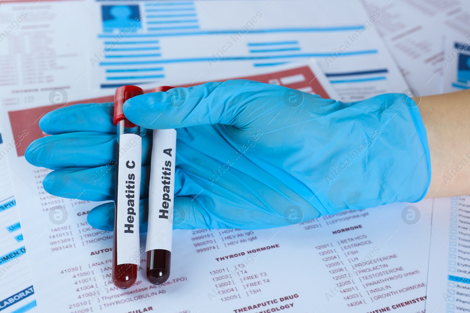 Photo of Scientist holding tubes with blood samples for hepatitis virus test against laboratory forms, closeup