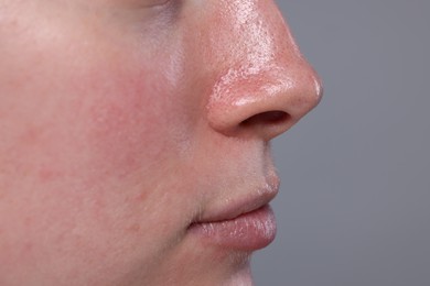 Closeup view of woman with reddened skin on grey background, space for text