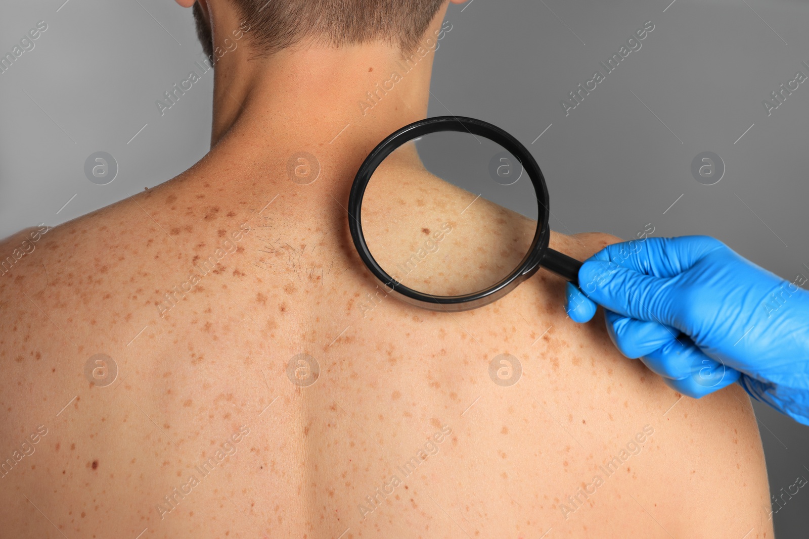 Photo of Dermatologist examining patient's birthmark with magnifying glass on grey background, closeup