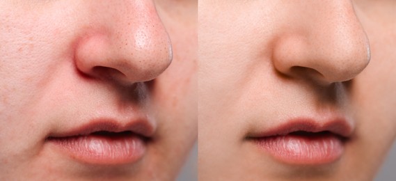 Image of Blackhead treatment, before and after. Collage with photos of woman, closeup view