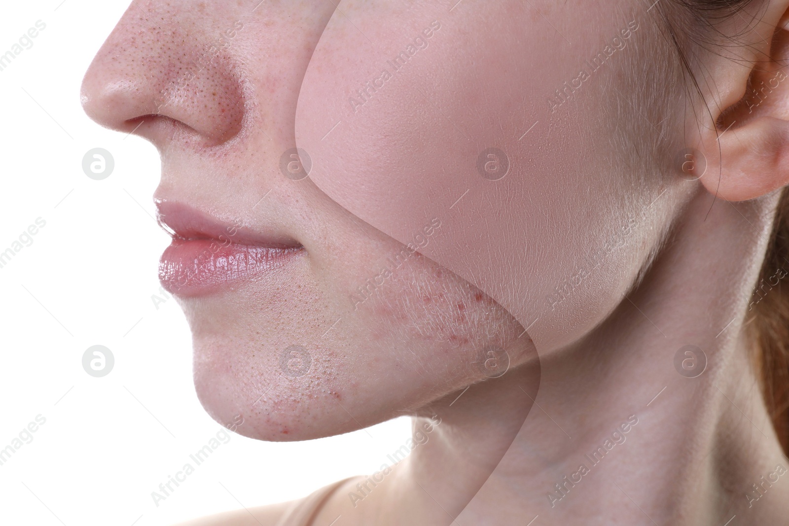 Image of Acne problem, collage. Photo of woman divided into halves before and after treatment on white background, closeup