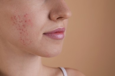 Photo of Young woman with acne problem on beige background, closeup. Space for text