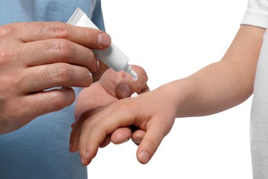 Photo of Father applying ointment onto his daughter's hand against white background, closeup