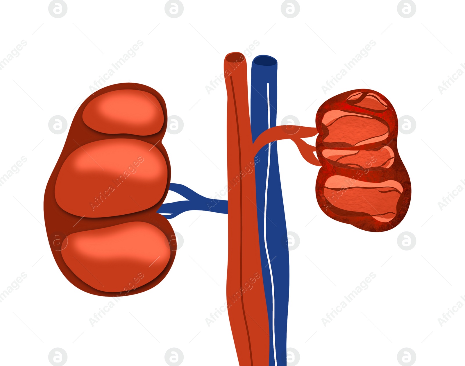 Illustration of  healthy and diseased kidneys on white background