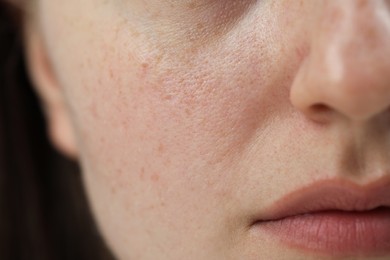 Photo of Macro view of woman with dry skin