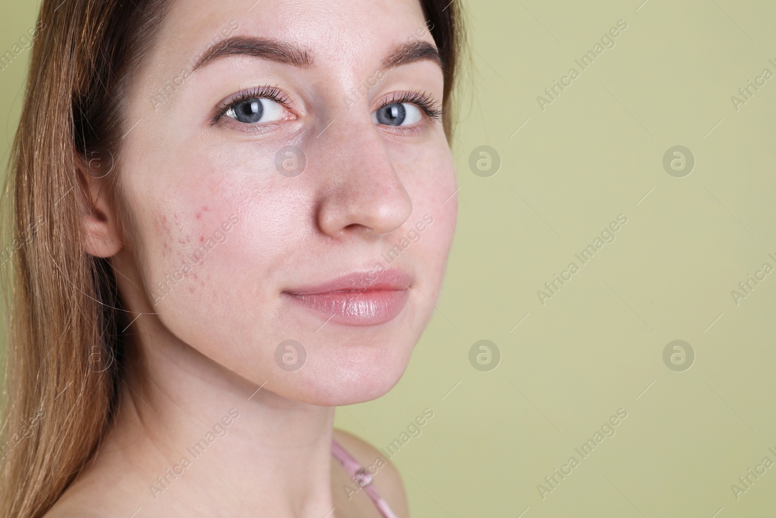 Photo of Young woman with acne problem on olive background, closeup. Space for text