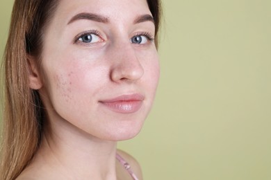 Photo of Young woman with acne problem on olive background, closeup. Space for text
