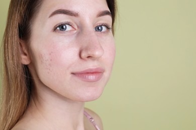 Young woman with acne problem on olive background, closeup. Space for text