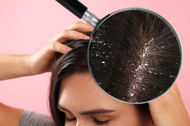 Woman suffering from dandruff on pink background, closeup. View through magnifying glass on hair with flakes