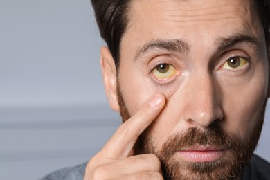 Man with yellow eyes on blurred background, closeup. Symptom of hepatitis
