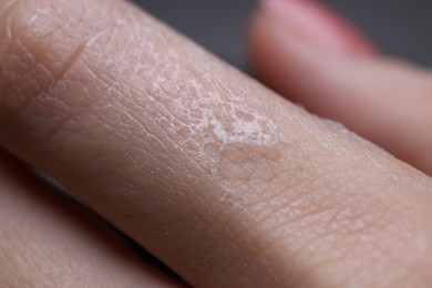 Woman with dry skin on hand, macro view