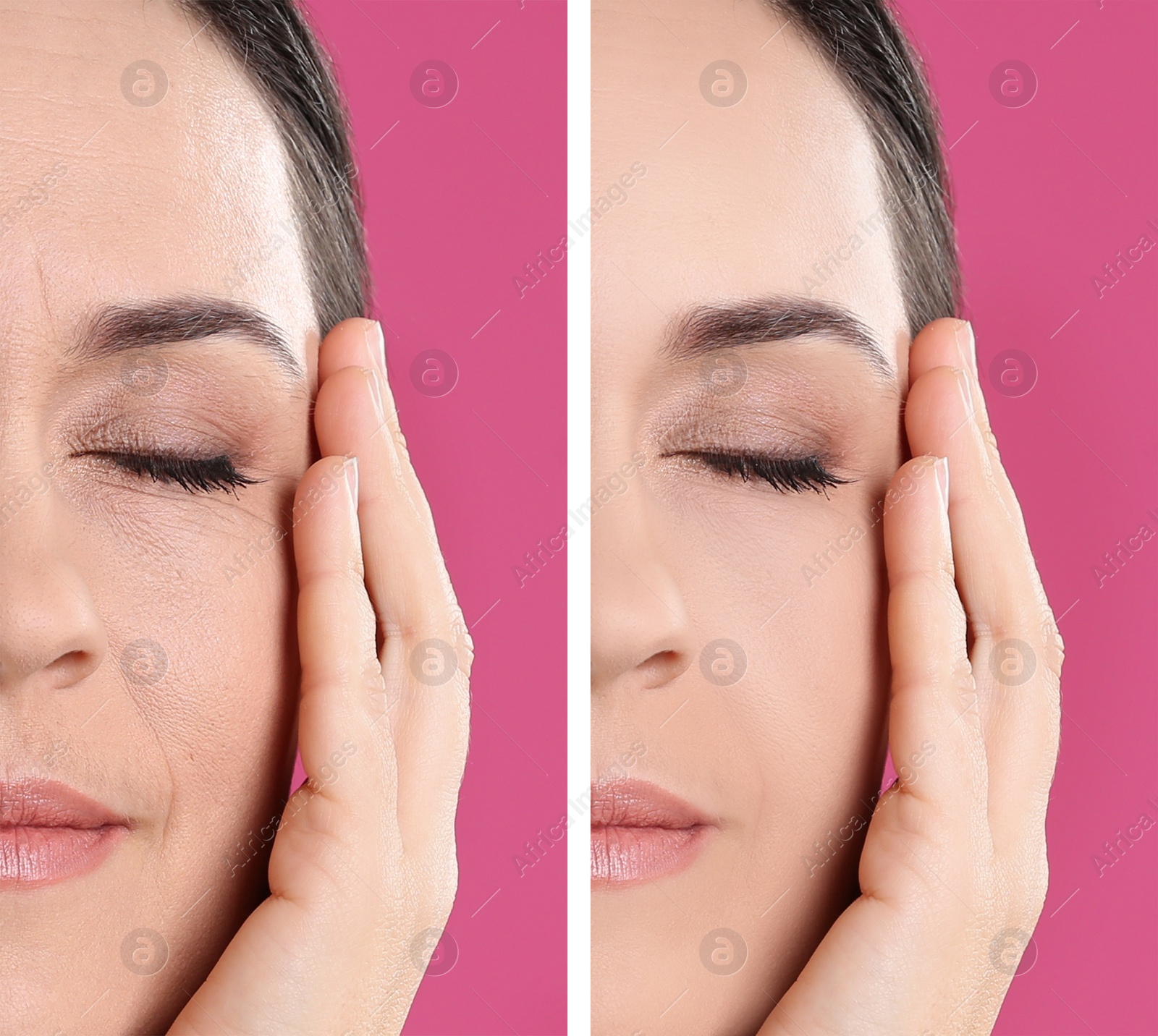 Image of Collage with photos of mature woman before and after biorevitalization procedure on pink background, closeup