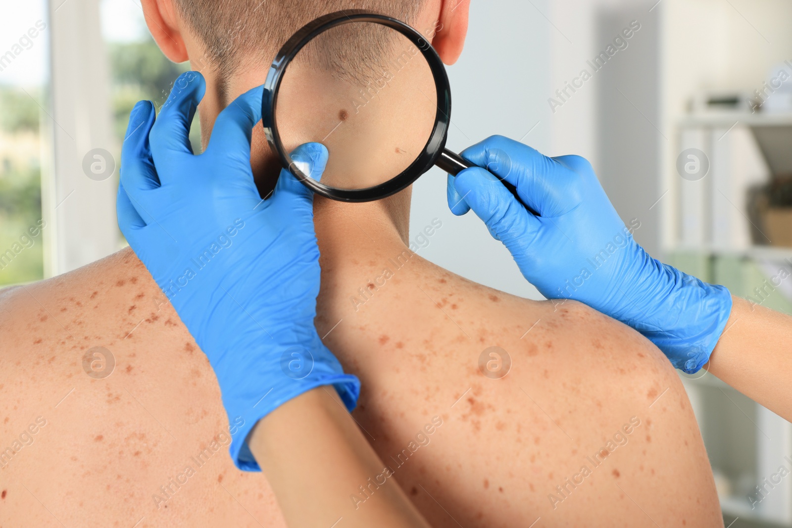 Photo of Dermatologist examining patient's birthmark with magnifying glass in clinic, closeup