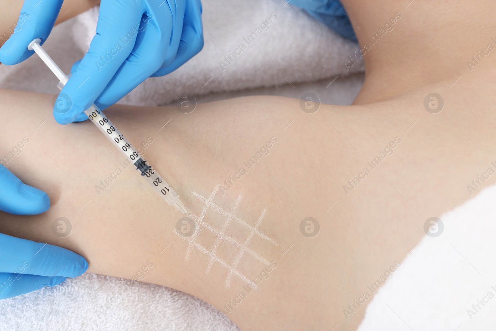 Photo of Cosmetologist injecting young woman's armpit, closeup. Treatment of hyperhidrosis