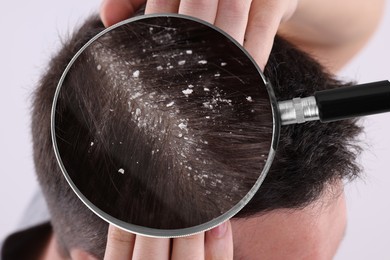 Man suffering from dandruff on light background, closeup. View through magnifying glass on hair with flakes