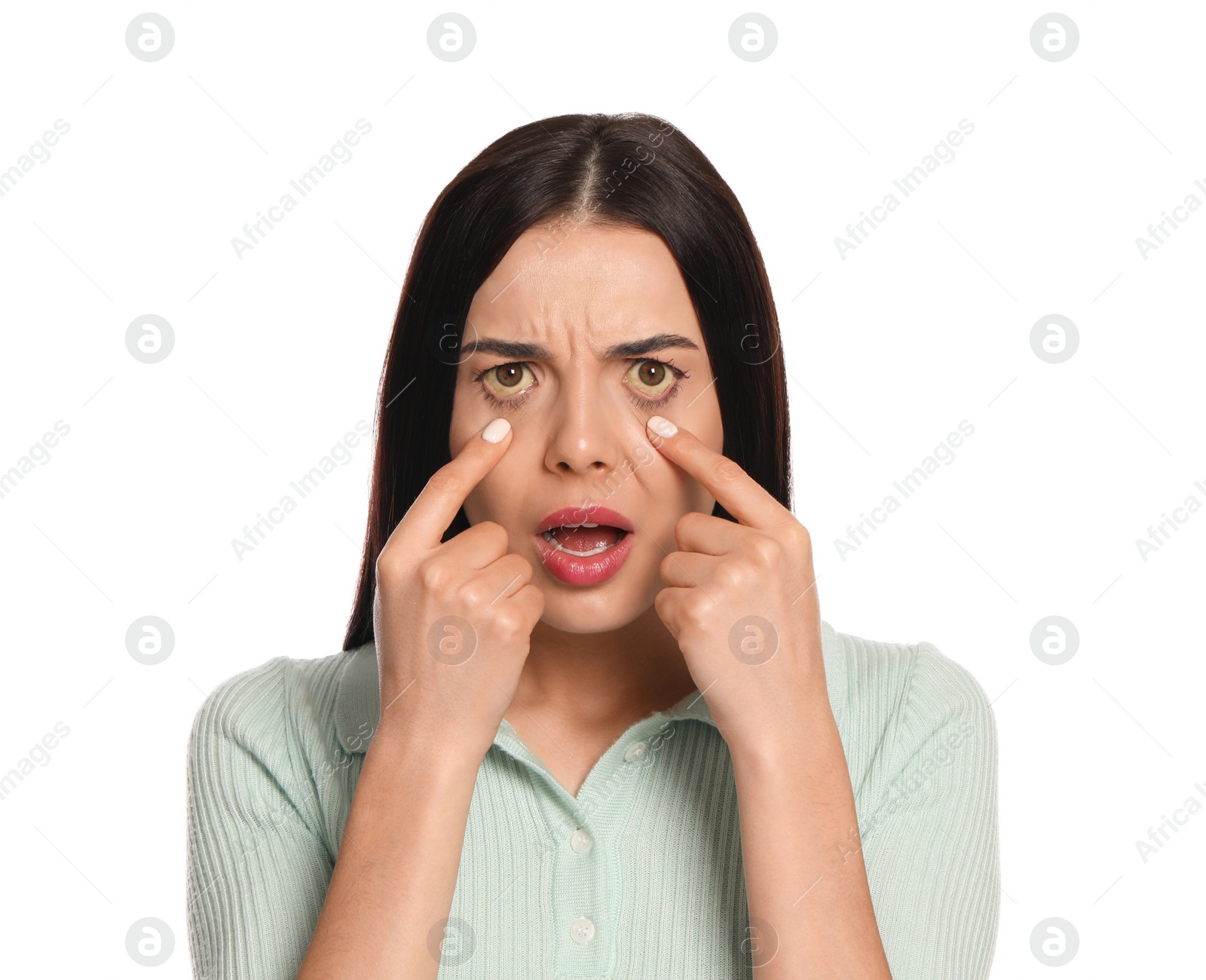 Photo of Woman checking her health condition on white background. Yellow eyes as symptom of problems with liver