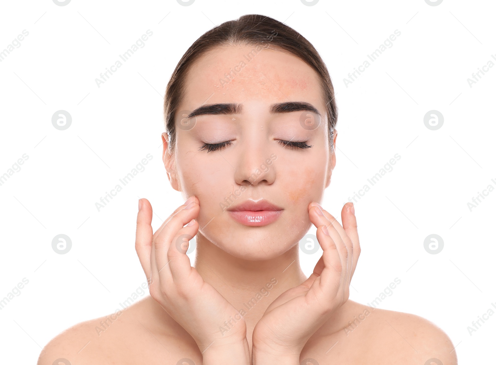 Image of Young woman with dry skin on white background