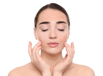 Young woman with dry skin on white background