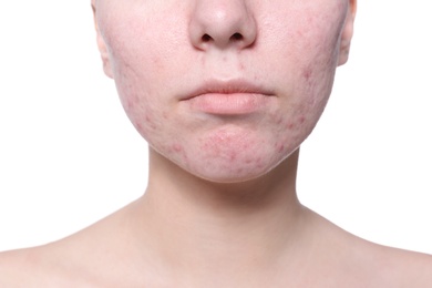 Photo of Young woman with acne problem on white background