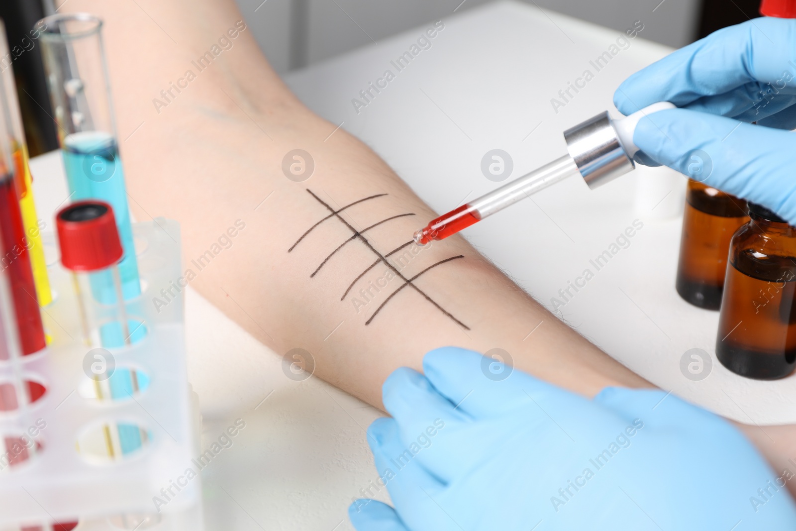 Photo of Doctor doing skin allergy test at light table, closeup