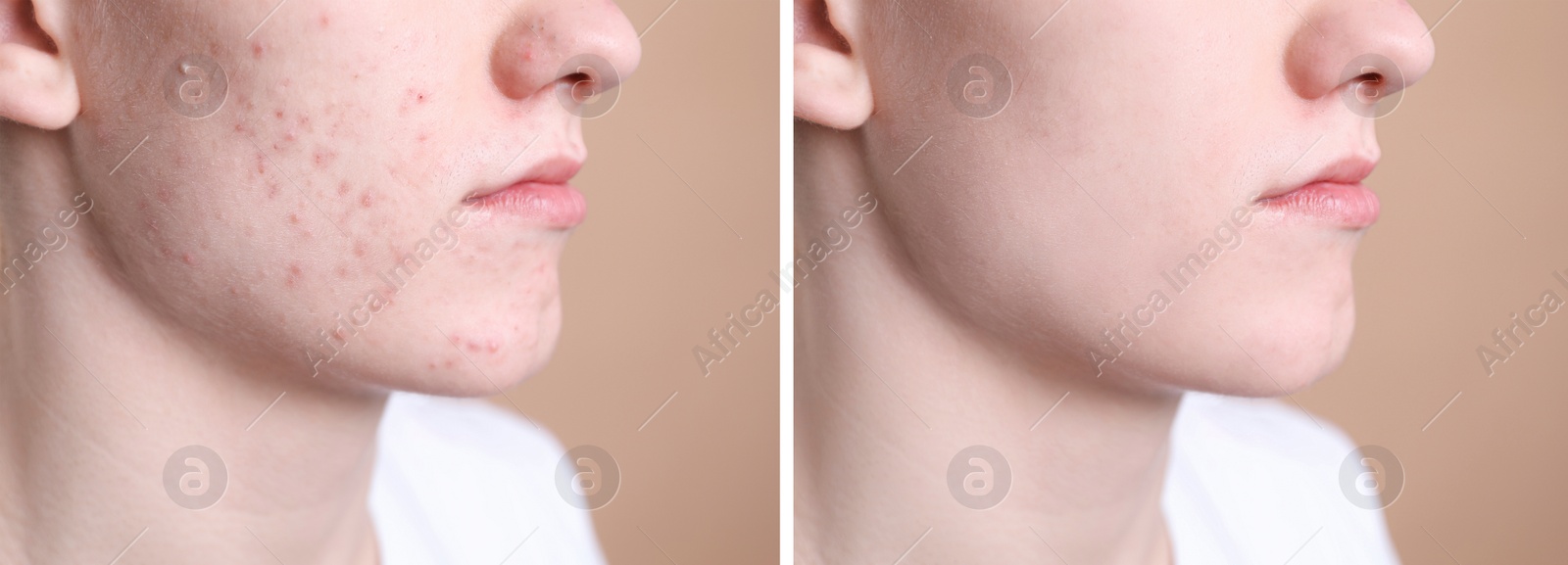 Image of Acne problem. Young man before and after treatment on beige background, closeup. Collage of photos