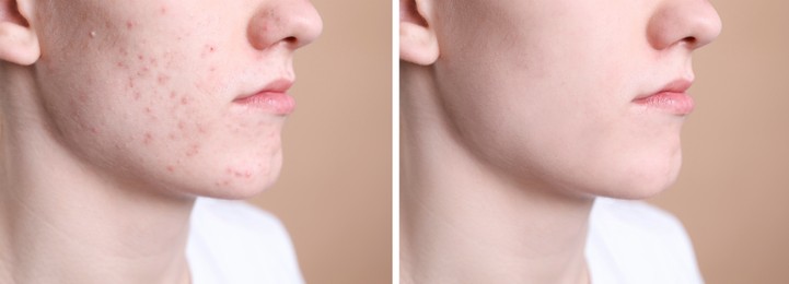 Acne problem. Young man before and after treatment on beige background, closeup. Collage of photos