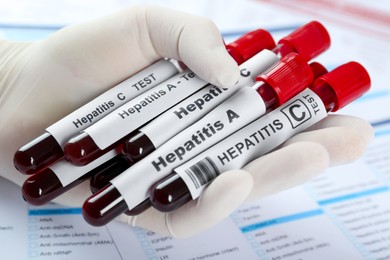 Scientist holding tubes with blood samples for hepatitis virus test against laboratory forms, closeup