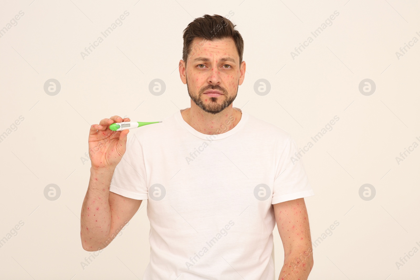 Photo of Man with rash holding thermometer on beige background. Monkeypox virus diagnosis