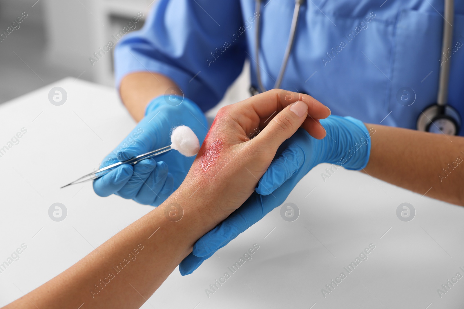 Photo of Doctor treating patient's burned hand at table, closeup