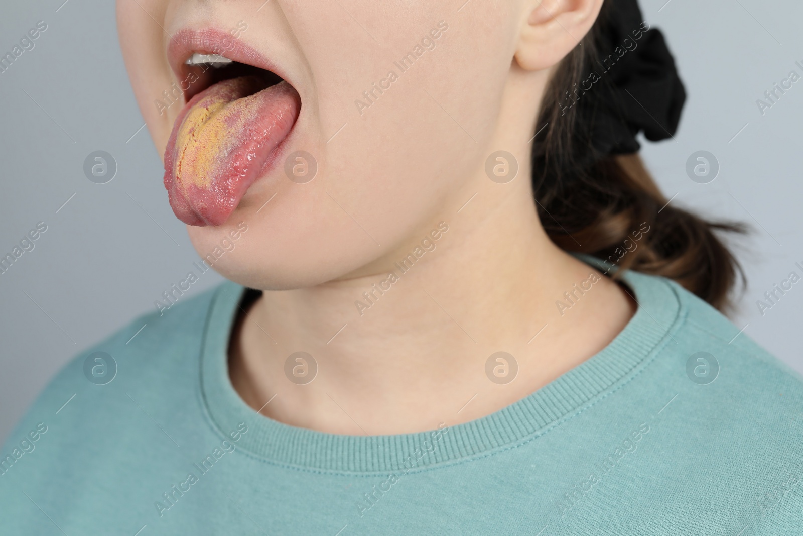 Photo of Gastrointestinal diseases. Woman showing her yellow tongue on light grey background, closeup